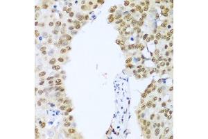 Immunohistochemistry of paraffin-embedded human lung cancer using HDAC1 antibody. (HDAC1 anticorps  (AA 393-482))