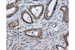 Immunohistochemical staining of paraffin-embedded Adenocarcinoma of colon tissue using anti-TPMT mouse monoclonal antibody. (TPMT anticorps)