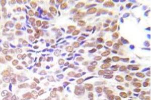 Immunohistochemistry (IHC)analyzes of HDAC1 antibody in paraffin-embedded human lung adenocarcinoma tissue. (HDAC1 anticorps)