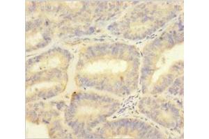 Immunohistochemistry of paraffin-embedded human endometrial cancer using ABIN7166030 at dilution of 1:100 (S1A1 (AA 2-94) anticorps)