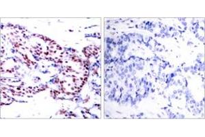 Immunohistochemistry analysis of paraffin-embedded human breast carcinoma tissue, using ATF2 (Ab-71 or 53) Antibody. (ATF2 anticorps  (AA 38-87))