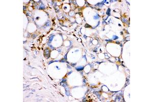 Anti- GPX1 antibody, IHC(P) IHC(P): Human Intestinal Cancer Tissue (Glutathione Peroxidase 1 anticorps  (Middle Region))