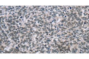 Immunohistochemistry of paraffin-embedded Human ovarian cancer tissue using TONSL Polyclonal Antibody at dilution 1:60 (NFKBIL2 anticorps)