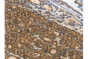 The image on the left is immunohistochemistry of paraffin-embedded Human thyroid cancer tissue using ABIN7130641(PIWIL4 Antibody) at dilution 1/25, on the right is treated with fusion protein. (PIWIL4 anticorps)