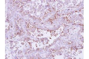 IHC-P Image Immunohistochemical analysis of paraffin-embedded human lung cancer, using Laminin beta 3, antibody at 1:250 dilution. (Laminin beta 3 anticorps)