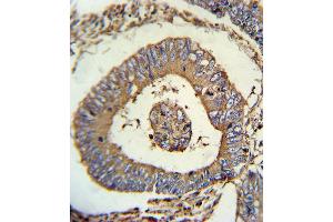 CALR Antibody immunohistochemistry analysis in formalin fixed and paraffin embedded human colon carcinoma followed by peroxidase conjugation of the secondary antibody and DAB staining.