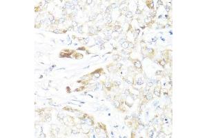 Immunohistochemistry of paraffin-embedded human liver cancer using HSD17B10 antibody.