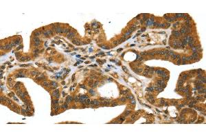Immunohistochemistry of paraffin-embedded Human thyroid cancer using STX11 Polyclonal Antibody at dilution of 1:30 (Syntaxin 11 anticorps)