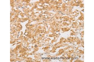 Immunohistochemistry of Human colon cancer using CD24 Polyclonal Antibody at dilution of 1:40 (CD24 anticorps)