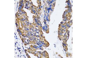 Immunohistochemistry of paraffin-embedded human gastric cancer using TP53 antibody (ABIN5973383) at dilution of 1/100 (40x lens). (p53 anticorps)