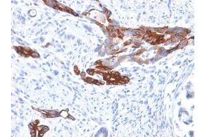 Formalin-fixed, paraffin-embedded human Gastric Carcinoma stained with MUC6 Rabbit Recombinant Monoclonal Antibody (MUC6/1553R). (Recombinant MUC6 anticorps)