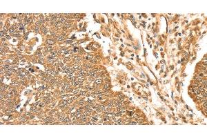Immunohistochemistry of paraffin-embedded Human lung cancer using ERK 5 Polyclonal Antibody at dilution of 1:35 (MAPK7 anticorps)