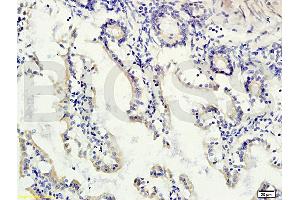Formalin-fixed and paraffin embedded human colon carcinoma labeled with Rabbit Anti-gremlin Polyclonal Antibody (ABIN687082) at 1:200 followed by conjugation to the secondary antibody and DAB staining. (GREM1 anticorps  (AA 101-184))