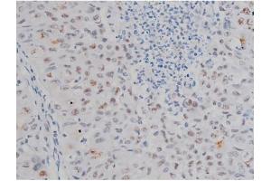 ABIN6267230 at 1/200 staining Human lung cancer tissue sections by IHC-P.