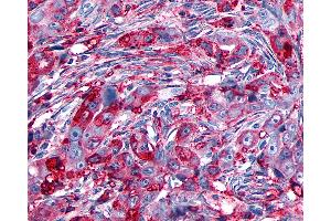 Anti-GPR133 antibody IHC of human Ovary, Carcinoma. (G Protein-Coupled Receptor 133 anticorps  (Cytoplasmic Domain))