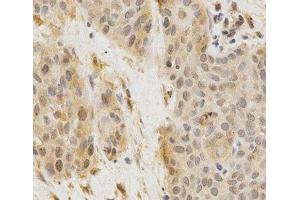 Immunohistochemistry of paraffin-embedded Human esophageal cancer using GGA2 Polyclonal Antibody at dilution of 1:200 (40x lens). (GGA2 anticorps)