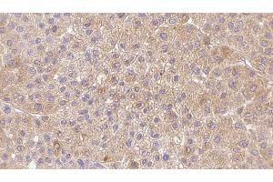 ABIN6273362 at 1/100 staining Human Melanoma tissue by IHC-P. (LDHAL6A anticorps  (Internal Region))