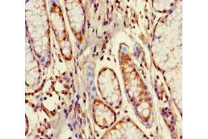 Immunohistochemistry of paraffin-embedded human gastric cancer using ABIN7164529 at dilution of 1:100 (GPX8 anticorps  (AA 41-209))