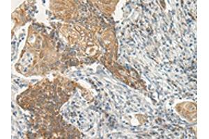 The image on the left is immunohistochemistry of paraffin-embedded Human cervical cancer tissue using ABIN7193020(VIPR2 Antibody) at dilution 1/35, on the right is treated with synthetic peptide. (VIPR2 anticorps)