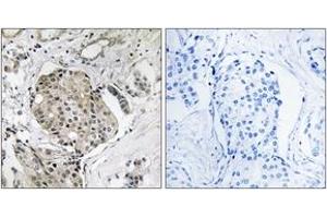 Immunohistochemistry analysis of paraffin-embedded human breast carcinoma, using USP40 Antibody. (USP40 anticorps  (AA 1011-1060))
