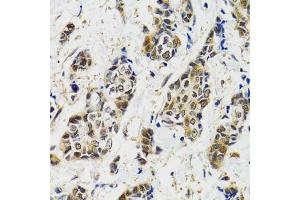 Immunohistochemistry of paraffin-embedded human breast cancer using MAPK9 antibody.