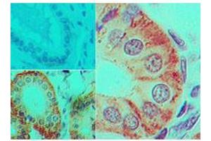 Immunohistochemistry of Mouse Anti-IL-17F antibody Tissue: human colon tissue Fixation: formalin-fixed, paraffin-embedded Primary antibody: isotype control (top left) , Mouse Anti-IL-17F antibody (bottom left, right) at 5 ug/ml (IL17F anticorps)