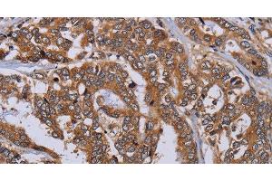Immunohistochemistry of paraffin-embedded Human liver cancer tissue using MFAP3L Polyclonal Antibody at dilution 1:50 (MFAP3L anticorps)