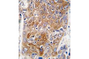 Formalin-fixed and paraffin-embedded human hepatocarcinoma tissue reacted with ALDH1L1 antibody (C-term), which was peroxidase-conjugated to the secondary antibody, followed by DAB staining. (ALDH1L1 anticorps  (C-Term))