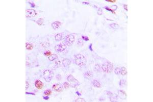Immunohistochemical analysis of ATF2 (pT69) staining in human lung cancer formalin fixed paraffin embedded tissue section. (ATF2 anticorps  (N-Term, pSer69))