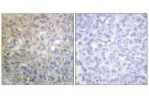 Immunohistochemistry analysis of paraffin-embedded human breast carcinoma tissue using FGFR1 (Ab-766) antiobdy. (FGFR1 anticorps  (Tyr766))