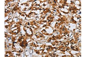 The image on the left is immunohistochemistry of paraffin-embedded Human thyroid cancer tissue using ABIN7190509(DSP Antibody) at dilution 1/40, on the right is treated with synthetic peptide.
