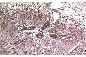Immunohistochemistry of paraffin-embedded Human colon carcinoma tissue using MMP2 Monoclonal Antibody at dilution of 1:200.