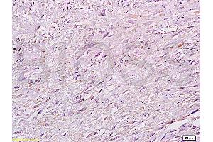 Formalin-fixed and paraffin: human cervical carcinoma labeled with Anti-RB1CC1 Polyclonal Antibody (ABIN872758), Unconjugated at 1:200 followed by conjugation to the secondary antibody and DAB staining