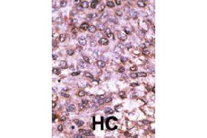 Formalin-fixed and paraffin-embedded human hepatocellular carcinoma tissue reacted with MAGEL2 polyclonal antibody  , which was peroxidase-conjugated to the secondary antibody, followed by DAB staining. (MAGE-Like 2 anticorps  (C-Term))