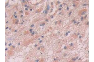 DAB staining on IHC-P; Samples: Human Glioma Tissue (Anion/Sugar Transporter anticorps  (AA 146-405))