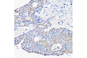 Immunohistochemistry of paraffin-embedded Human colon carcinoma using  Rabbit pAb (ABIN7265368) at dilution of 1:100 (40x lens). (ACAA2 anticorps  (AA 1-250))