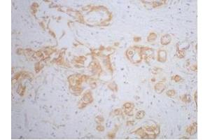 Immunohistochemistry (IHC) staining of Human Breast cancer tissue, diluted at 1:200. (beta Catenin anticorps)