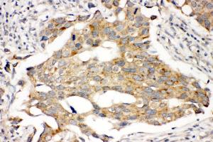 Anti-Prolactin Receptor antibody, IHC(P) IHC(P): Human Mammary Cancer Tissue