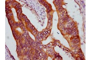 IHC image of ABIN7157699 diluted at 1:600 and staining in paraffin-embedded human colon cancer performed on a Leica BondTM system.