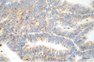 Immunohistochemistry was performed on paraffin-embedded human endometrial carcinoma using vimentin antibody (ABIN7800838), 1:100).