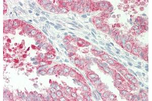 Rabbit Anti-HBEGF antibody Catalog Number: ARP45201 Formalin Fixed Paraffin Embedded Tissue: Human Uterus Primary antibody Concentration: 1:100 Secondary Antibody: Donkey anti-Rabbit-Cy3 Secondary Antibody Concentration: 1:200 Magnification: 20x Exposure Time: 0.