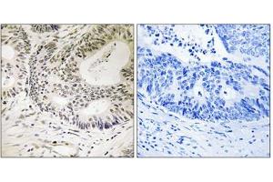 Immunohistochemical staining of paraffin-embedded human colon carcinoma tissue reacted with TP53BP1 (phospho S25) polyclonal antibody  at 1:50-1:100 dilution.