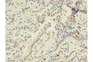 Immunohistochemistry of paraffin-embedded human lung cancer using ABIN7155356 at dilution of 1:100