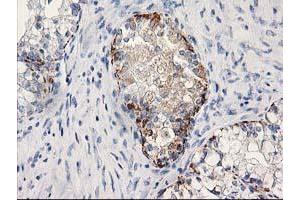 Immunohistochemical staining of paraffin-embedded Adenocarcinoma of Human ovary tissue using anti-MGLL mouse monoclonal antibody. (MGLL anticorps)
