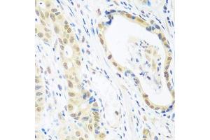 Immunohistochemistry of paraffin-embedded human stomach cancer using POLR2E antibody.