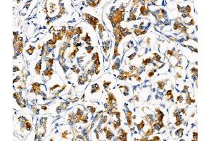 ABIN6259059 and ABIN6274712 at 1/100 staining Human pancreatic cancer and adjacent nomal tissues by IHC-P. (AGPAT5 anticorps  (Internal Region))