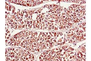Immunohistochemistry of paraffin-embedded human liver cancer using ABIN7165275 at dilution of 1:100