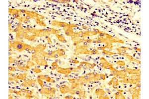 IHC image of ABIN7149956 diluted at 1:300 and staining in paraffin-embedded human liver cancer performed on a Leica BondTM system. (FMO3 anticorps  (AA 111-219))