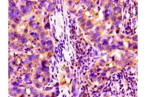 Immunohistochemistry of paraffin-embedded human pancreatic cancer using ABIN7148403 at dilution of 1:100 (Complement Factor I anticorps  (AA 239-316))