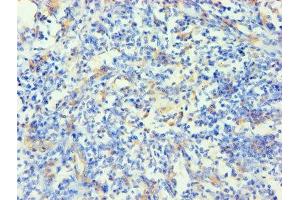 Immunohistochemistry of paraffin-embedded human cervical cancer using ABIN7157384 at dilution of 1:100 (KRT14 anticorps  (AA 1-472))